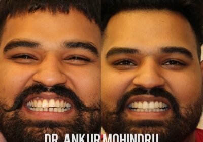 Dr.-Ankur-Mohindru-Best-dentist-in-amritsars