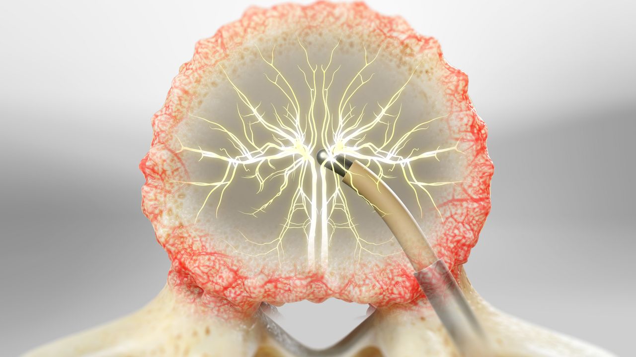 Basivertebral Nerve Ablation (BVN) San Antonio, TX