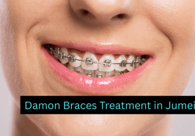 Damon-Braces