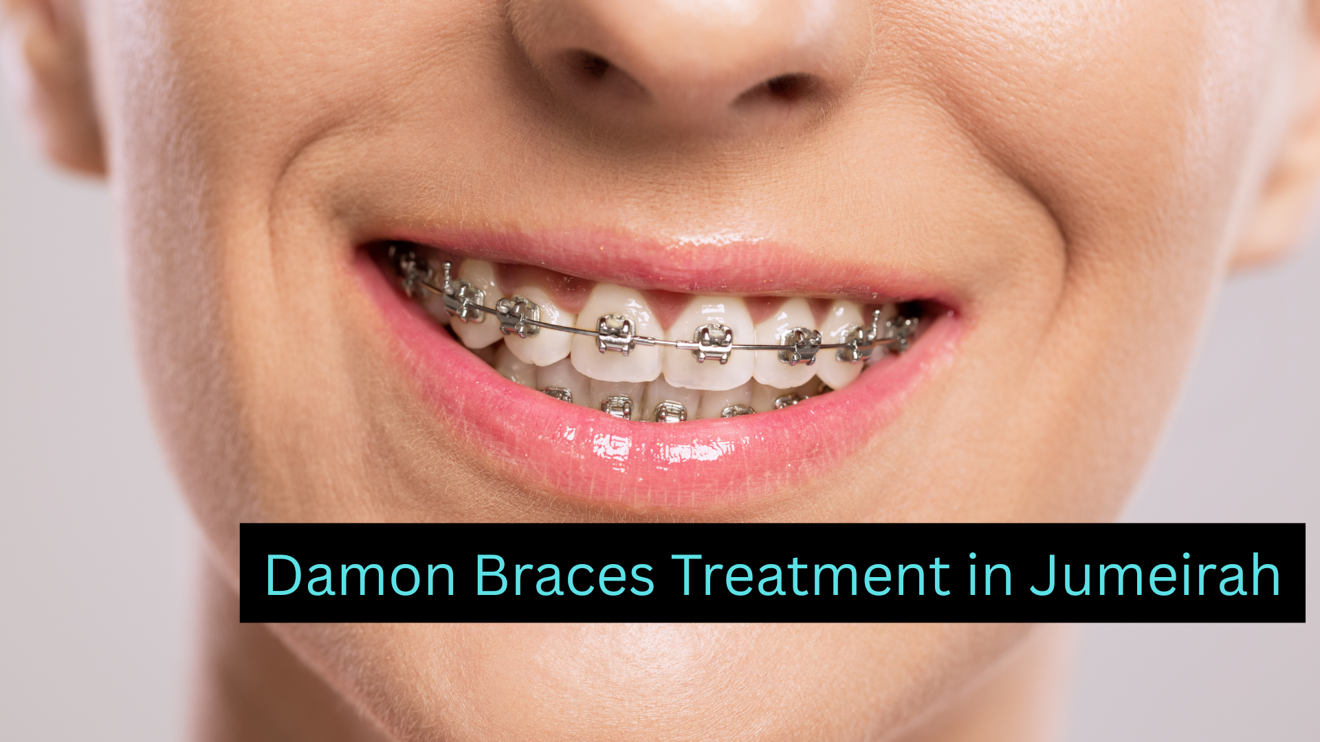 Damon Braces Treatment in Jumeirah