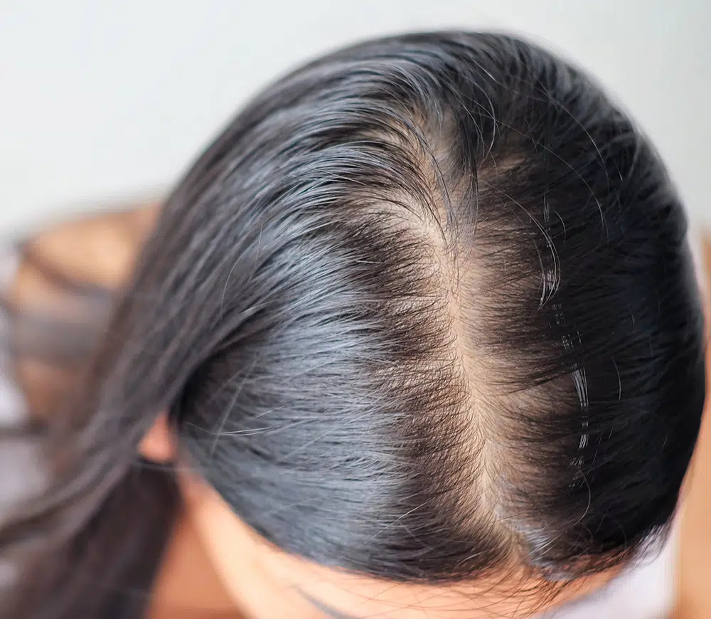 Leading Hair Loss Treatment Clinic in Noida