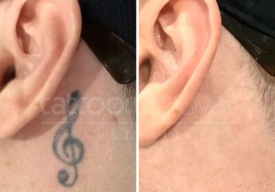 Tatto-removal-australia-before-and-after-results
