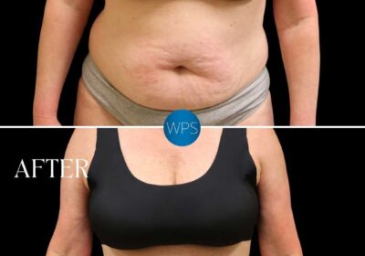 imgi_151_Dr.-Glener-BA-Tummy-Tuck4