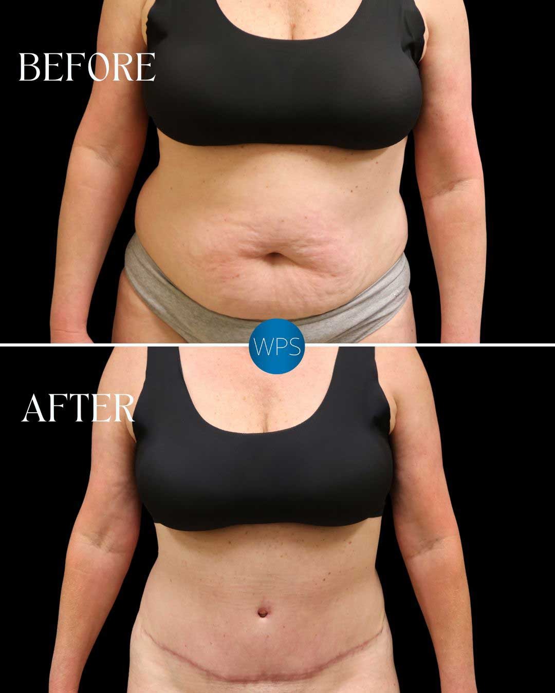 Tummy Tuck Plastic Surgeon Near Me